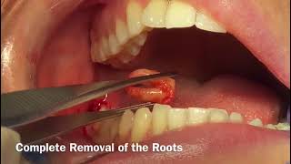 DSI Sponge Example of Use - 2nd molar extraction