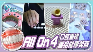 【優智能-全口重建ALL ON 4篇】多顆缺牙無法好好進食〡ALL ON 4價格低迅速完成全口重建 #全口重建 #黃金全瓷冠