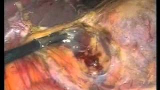 Laparoscopic Left Adrenalectomy for a Large Virilizing Tumor