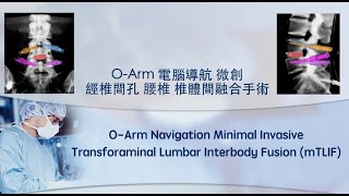 O-arm 電腦導航 微創 經椎間孔 腰椎 椎體間融合手術 (O-arm Navigation TLIF)