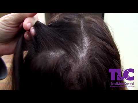 TLC Shows the difference between Lice and dandruff TLC Shows the difference between Lice and dandruff