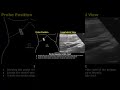 Caudate Lobe, Porta Hepatis, CBD Probe Positioning | Liver Ultrasound Transducer Placement |#shorts