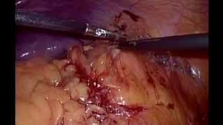 How I Do It: Laparoscopic Renal Cryoablation (LRC)