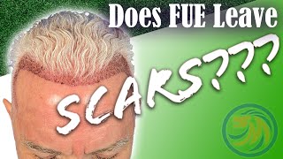 FUE Scars - Hair Transplant Results