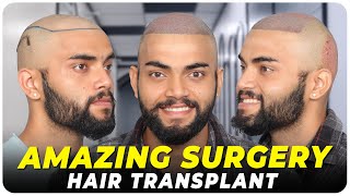 Hair Transplant in Amritsar | Best Results & Cost of Hair Transplant in Amritsar