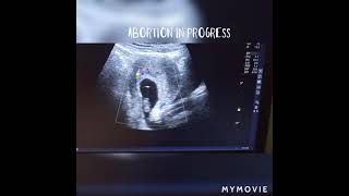 Abortion In Progress Ultrasound Case