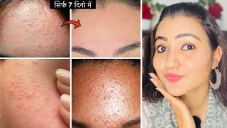 मुश्किल से मुश्किल *Tiny Bumps White Bumps* सफ़ेद दाने Uneven Skintone, Dark Spots का 100% इलाज़ 💕