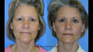 ImageLift Consultation Video Castellano Facelift 877.346.2435