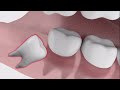 how to safely and quickly have a wisdom tooth extraction