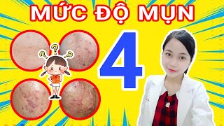 Mụn trứng cá của bạn đang ở MỨC ĐỘ nào ? 4 MỨC ĐỘ CỦA MỤN TRỨNG CÁ | Bs. Nguyễn Ngọc