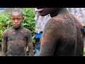 Our 15-Year-Old Boy With 'snake-like' skin condition : BORN DIFFERENT