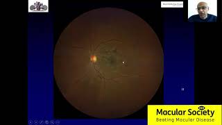 Diabetic Macular Oedema