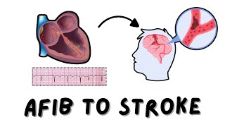 How Atrial Fibrillation Leads to Stroke?