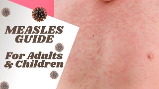 Measles Symptoms, Causes, Diagnosis, Treatment \u0026 Prevention