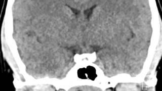 Nasopharyngeal Mucous Retention Cyst