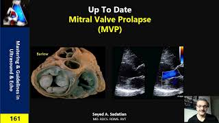 Mitral Valve Prolapse (MVP)