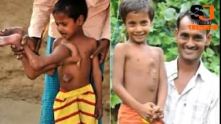 A Boy Who was Born with Extra Limbs on His Chest