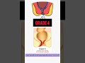 grading of hemorrhoides medilectures medicine surgery baileyand love