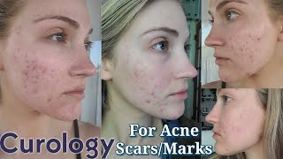 I Used Curology For Acne Scars \u0026 Hyperpigmentation (1 Month Results) *NOT SPONSORED