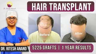 🔴 Hair Transplant Journey: 5000 Grafts with 1 Year Results | Best Hair Transplant in Delhi NCR