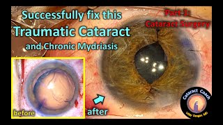 Cataract surgery of a traumatic cataract with zonular loss and iris damage