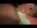 Mike Swann, MD treats nasal vessles using KTP Gemini Laser.mov