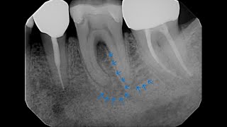 [21] What does a successful root canal look like?