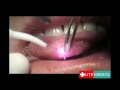 laser lingual fibroma removal by litemedics