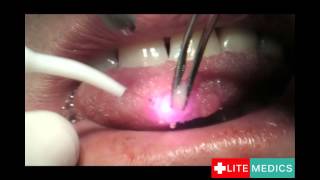 Laser Lingual Fibroma Removal by LITEMEDICS