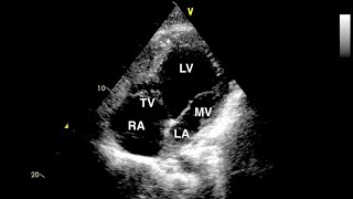 Double Inlet Left Ventricle Echocardiogram