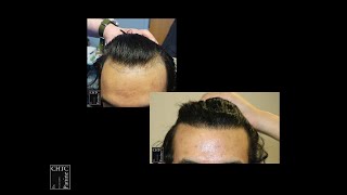 Before and After Photos of a 2,500 Graft FUE Hair Transplant at CHICAGO HAIR TRANSPLANT CLINIC