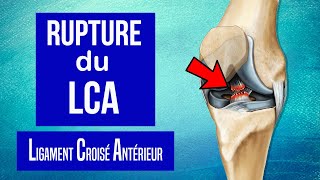 Rupture du Ligament Croisé Antérieur du genou (LCA) : Les traitements