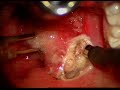 coblation tonsillectomy