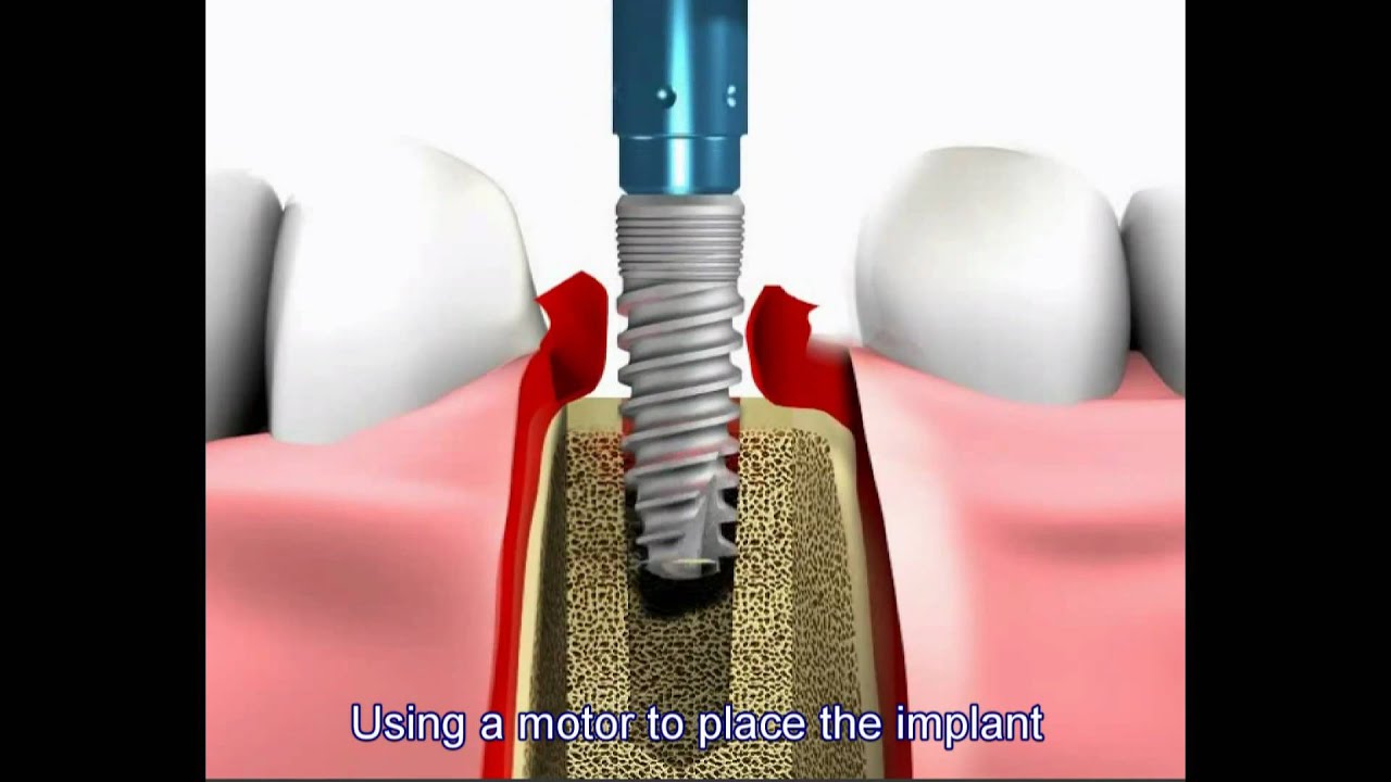 Dental Implant Procedure Youtube