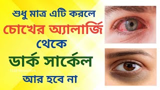 চোখের এলার্জি দূর করার ঘরোয়া উপায়  |  Eye Allergy Home Remedies | চোখের এলার্জি দূর করার উপায়