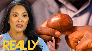 Dr. Lee Calls In A Specialist To Transform Gerard’s Finger And Change His Life I Dr. Pimple Popper