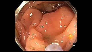 Colonoscopy: Inspection - assess polyp - Skirt lesion identified