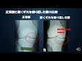 東都リハビリテーション学院webオープンキャンパス体験講座　第１３回「acl損傷とリハビリテーション②」