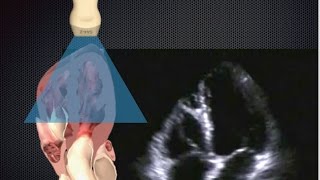 Basic Cardiac Ultrasound Views 3: Apical 4 Chamber (A4C)