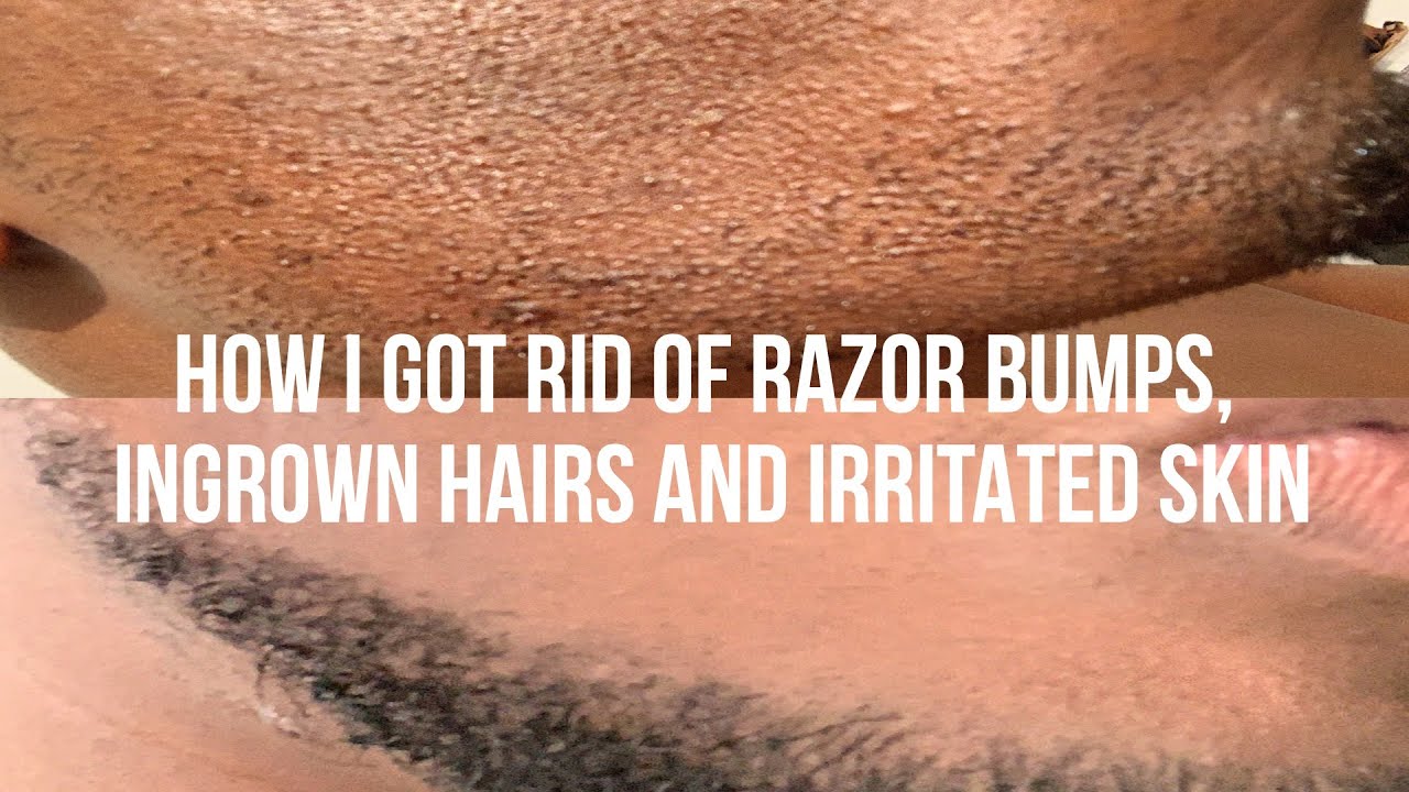 HOW I GOT RID OF RAZOR BUMPS AND INGROWN HAIRS - YouTube