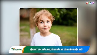 Bệnh lý lác mắt: Nguyên nhân và dấu hiệu nhận biết