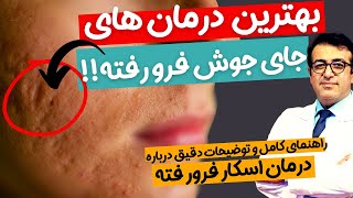 راهنمای کامل درمان اسکارهای فرورفته آکنه روش‌های موثر و تکنیک‌های جدید برای بهبود اسکارهای فرورفته