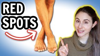 Why you get RED SPOTS ON THE LEGS & HOW TO GET RID OF THEM // Dermatologist @DrD