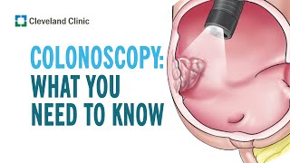 Colonoscopy: What you Need to Know