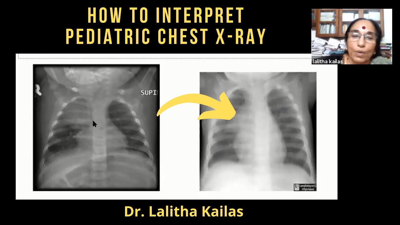 How To Read A Chest X-ray PDF: ABCDE Mnemonic, Step By Step, 57% OFF