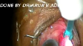 TRABECULECTOMY done by Dr.Arun V Adkoli