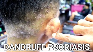 PSORIASIS apa benar penyebabnya dari ketombe||Full vidio(DANDRUFF INFLAMMATION).