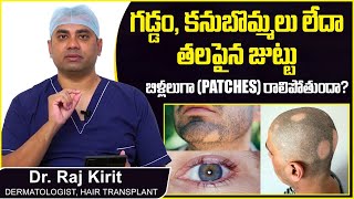 జుట్టు పట్టీల రాలితే | Alopecia Areata Causes and Symptoms | Patchy Hair Loss | Celestee Hair Clinic