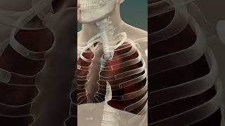 Pneumonia Explained