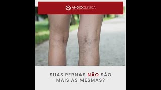 Os mais modernos tratamentos para eliminar seus vasinhos e varizes.